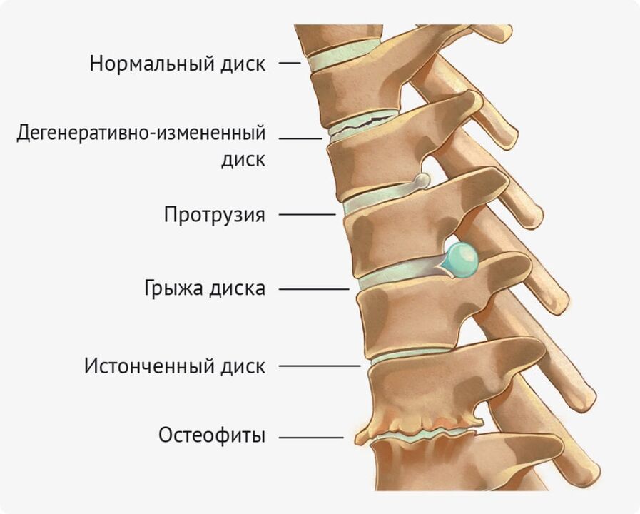 Intervertebral disc malformation in lumbar osteochondrosis