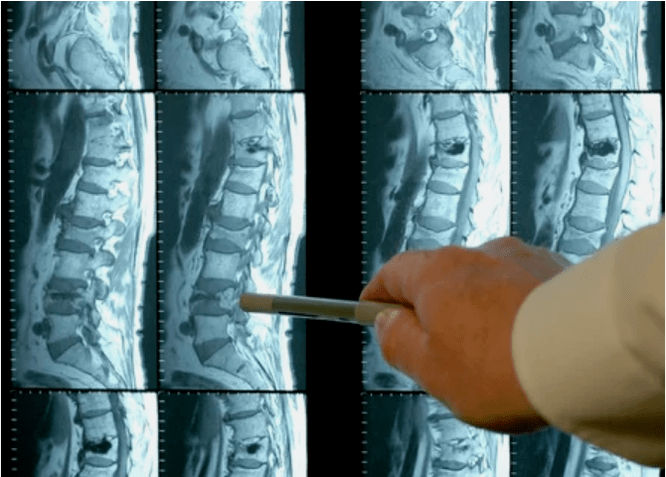 Variety of osteocartilage in the spine