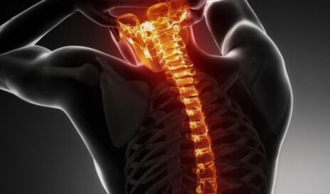 Osteochondral disease throughout the spine