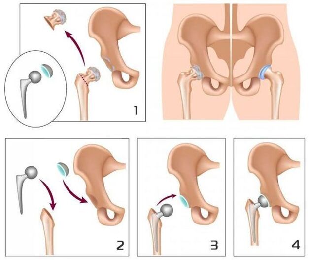 Replace a sore joint with prostheses