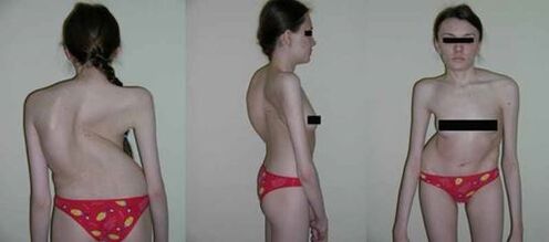 The curvature of the spine after osteocartilage degeneration