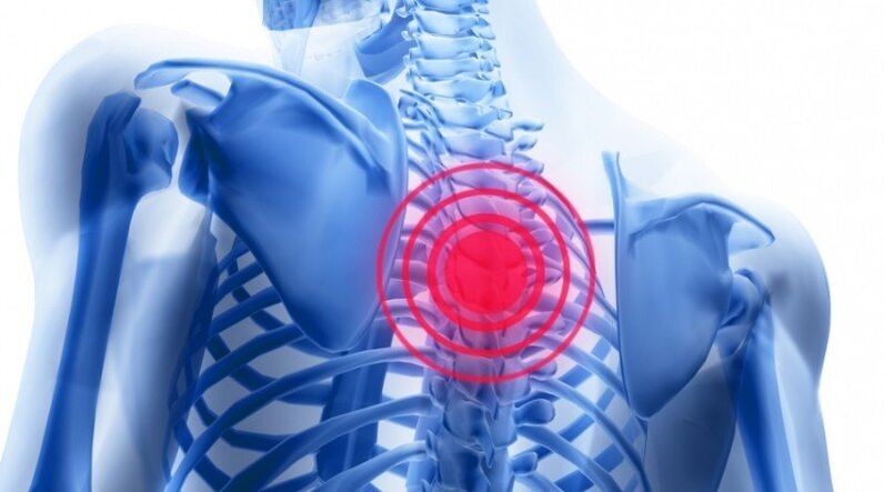 Back pain may be caused by a herniated disc