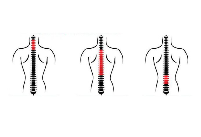 What are the symptoms of osteochondrosis