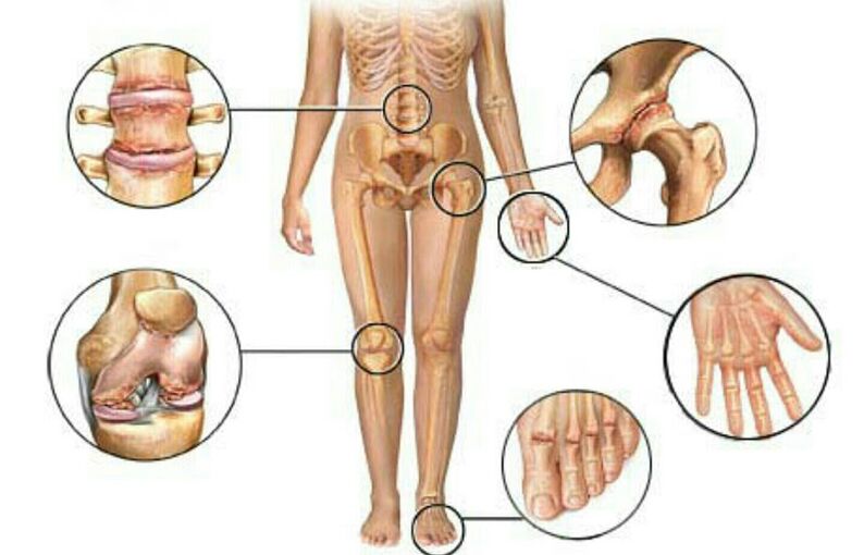 Type and degree of joint disease