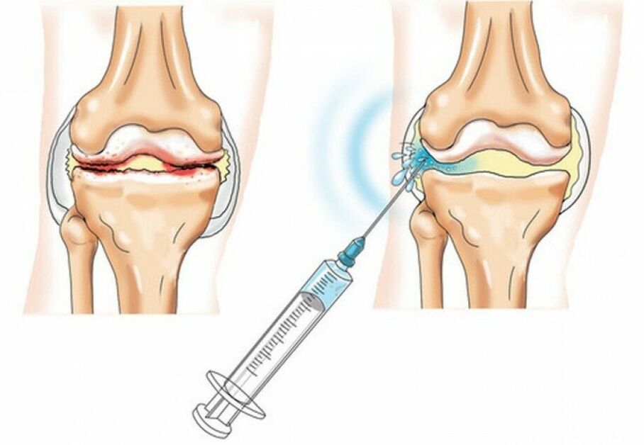 Arthropathy Knee Injection