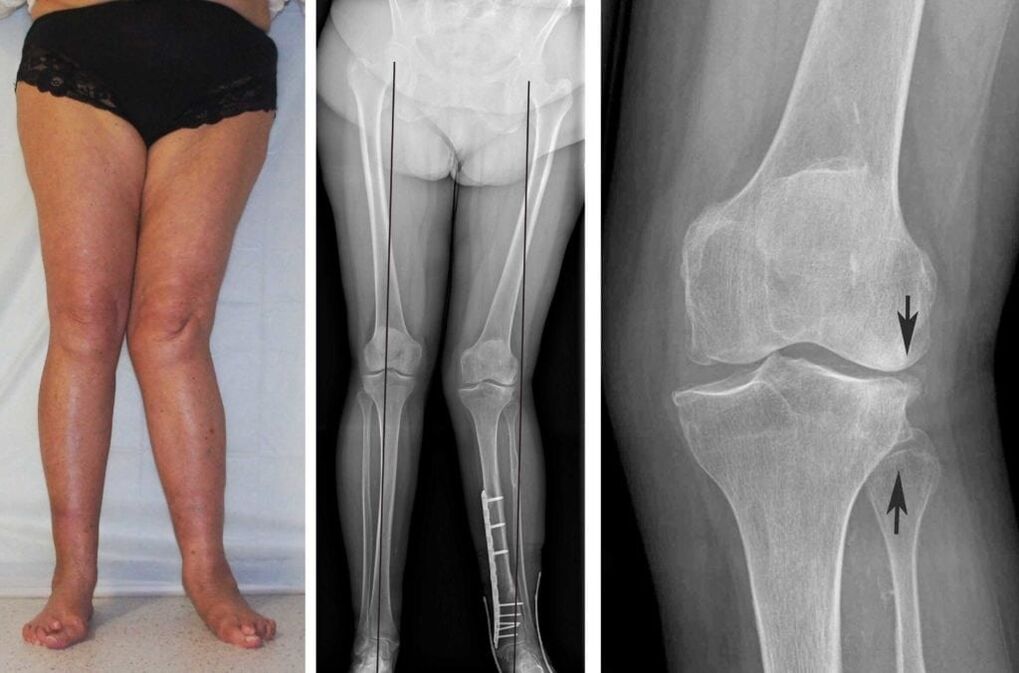 Advanced arthropathy of the knee is clearly visible even without X-rays
