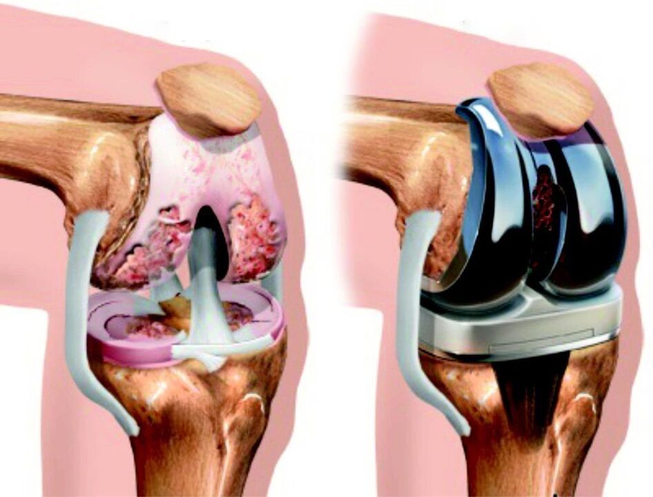 If the knee joint is completely damaged due to a joint injury, it can be restored with an internal prosthesis