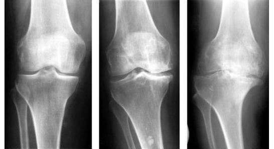 X-ray examination is mandatory diagnostic measure to identify knee arthritis